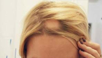 Hair loss type Alopecia Areata