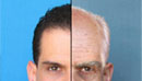 Hairtransplant optimal age