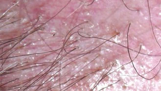 Hair loss form caused by Lichen plano-pilaris