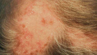 Hair loss due to Lupus Erythematosus