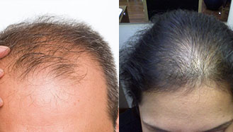 Pattern hair loss