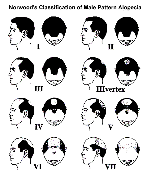 Men hair loss Norwood classification