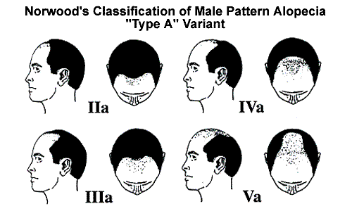 Men hair loss Norwood classification