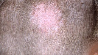 Hair loss due to Tinea Capitis