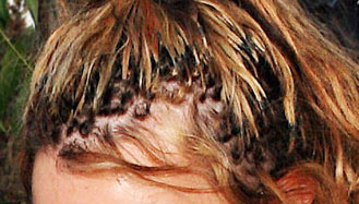 Traction Alopecia