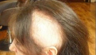 Hair loss trough Trichotillomania